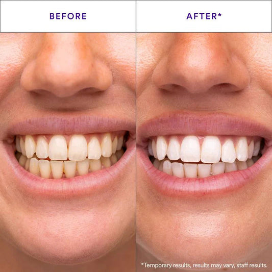 Auris Ash Whitening Strips 