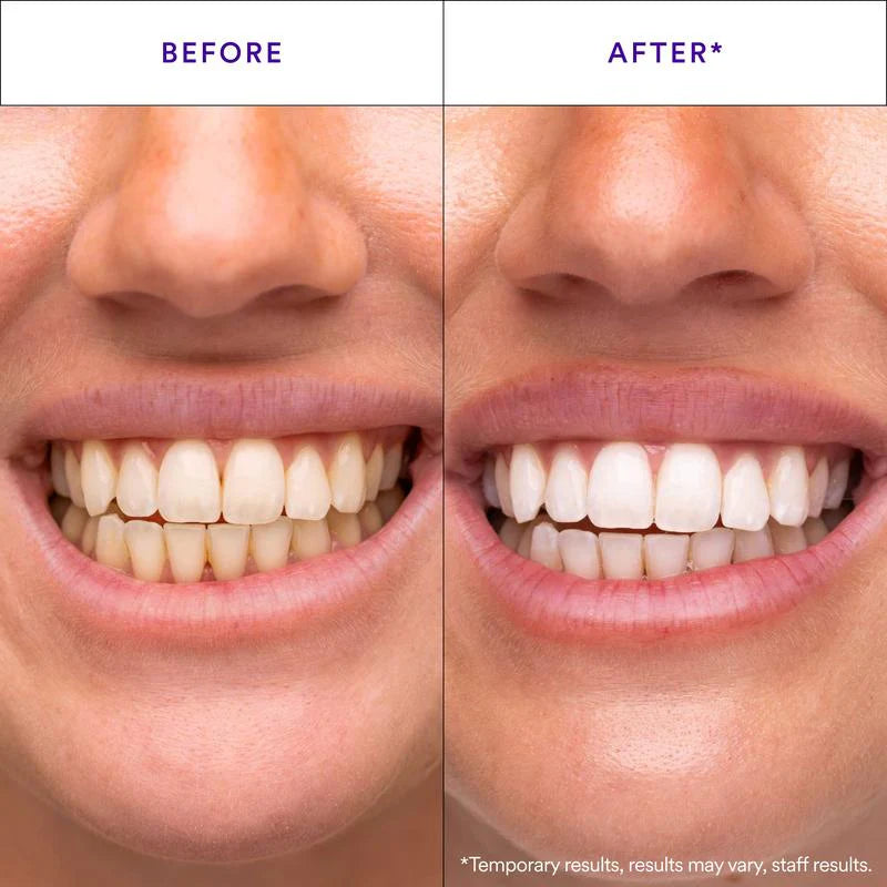 Auris Ash Whitening Strips ﻿